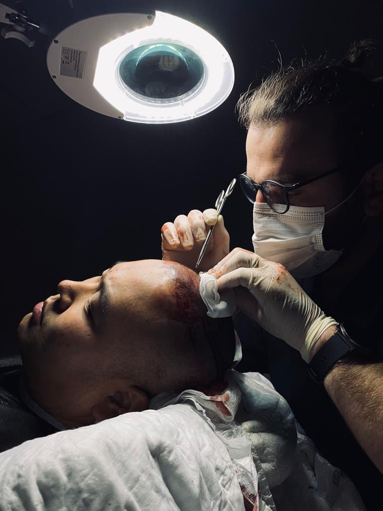 Channel opening stage of a hair transplant operation