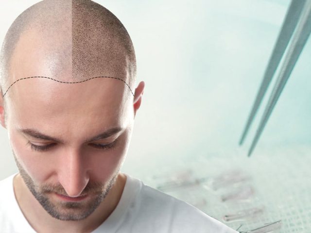 Common Myths About Hair Transplants
